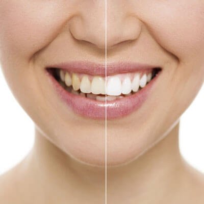 professional teeth whitening north shore image