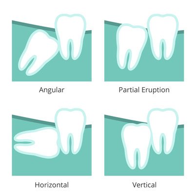 tooth decay in wisdom teeth image